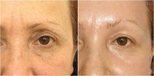 Фракционный фототермолиз кожи. Фото до и после. Клиника VITAL.